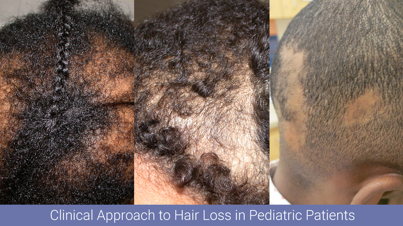 Hair disorders skin of color update