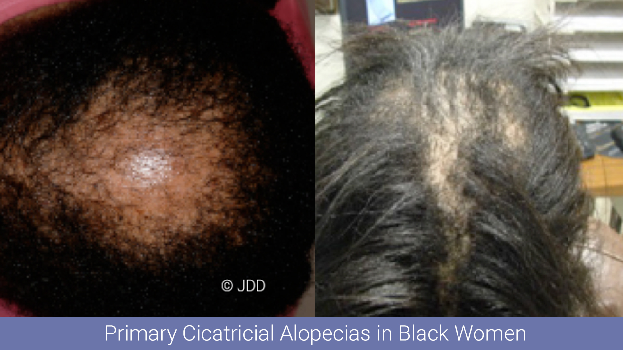Skin of Color Update CCCA