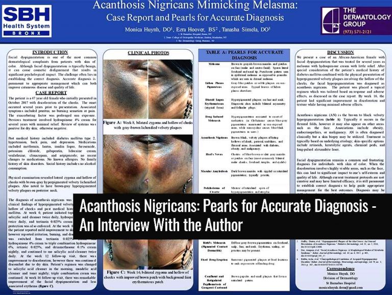 Acanthosis Nigricans Mimicking Melasma