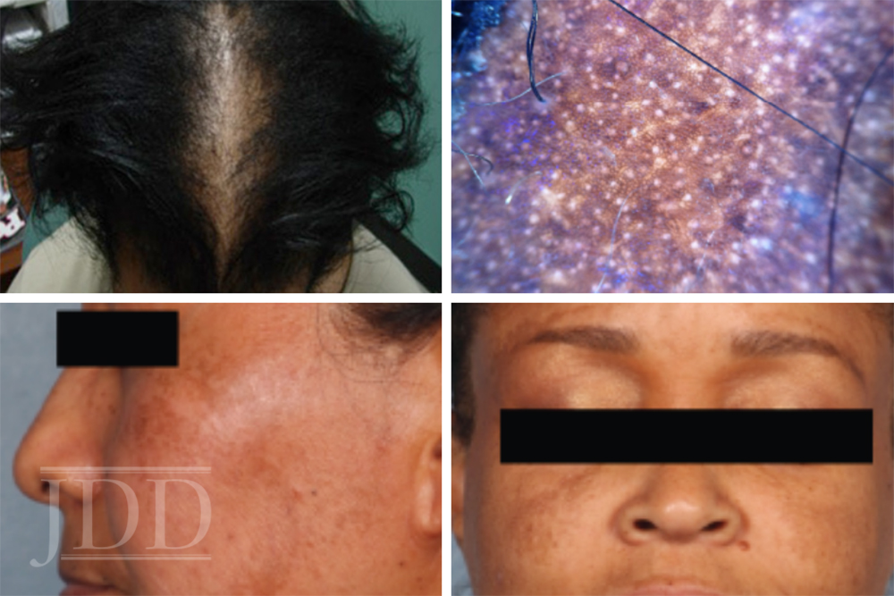 Medical Updates in Skin of Color