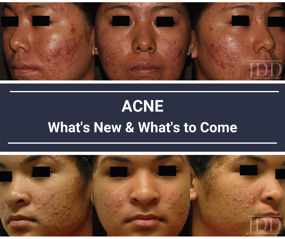 Acne in Skin of Color Alexis