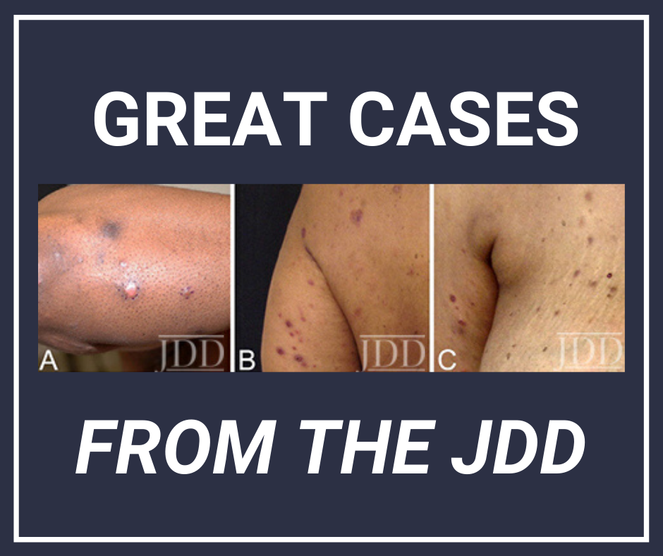Lymphomatoid Papulosis JDD Skin of Color