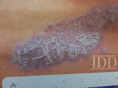 Pemphigus Foliaceus