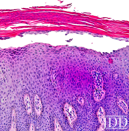 Pemphigus Foliaceus