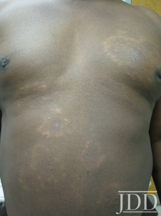Cutaneous Sarcoidosis