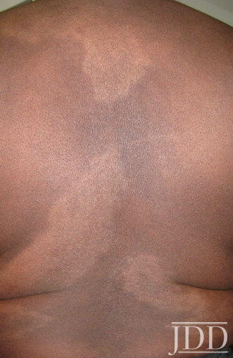 Cutaneous Sarcoidosis