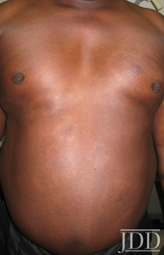 Cutaneous Sarcoidosis