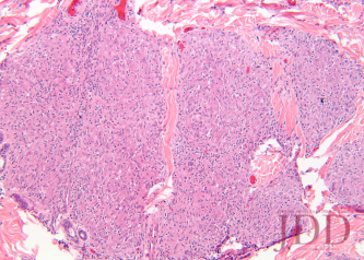 Cutaneous Sarcoidosis