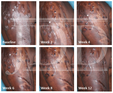 Black Male With Psoriasis and Dyspigmentation