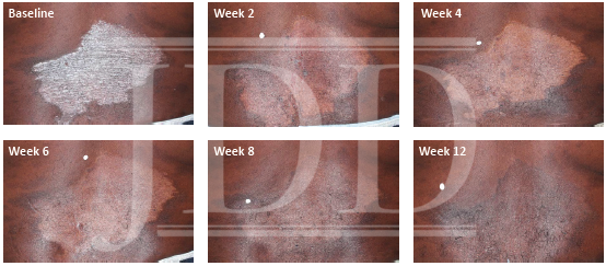 Black Male With Psoriasis and Dyspigmentation